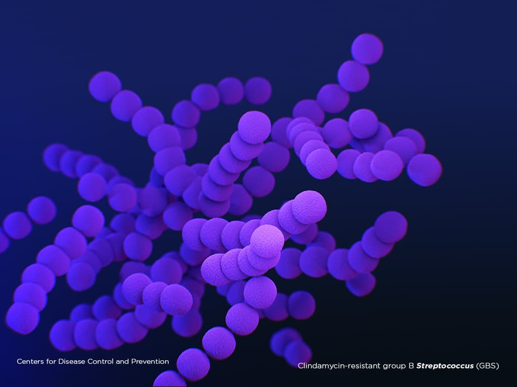 Illustration of Clindamycin-resistant group B Streptococcus